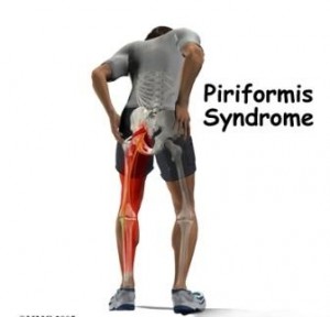 Piriformis-syndrome-trigger-point-therapy